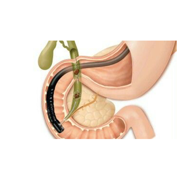 best Pancreatic Biliary Disorders treatment